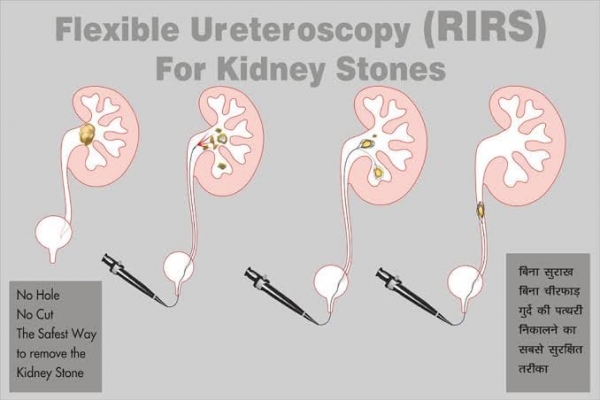 Effective Kidney Stone Removal Techniques: Break Free from the Pain!