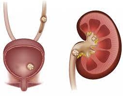 What causes kidney stones and what to do: FAQ